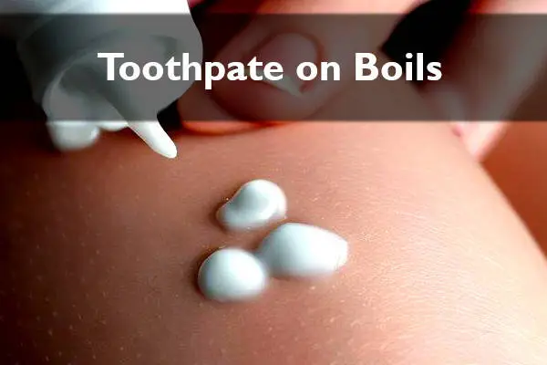 toothpaste on boils natural remedy treatment