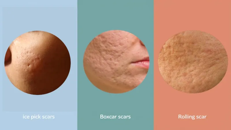 types of acne scars