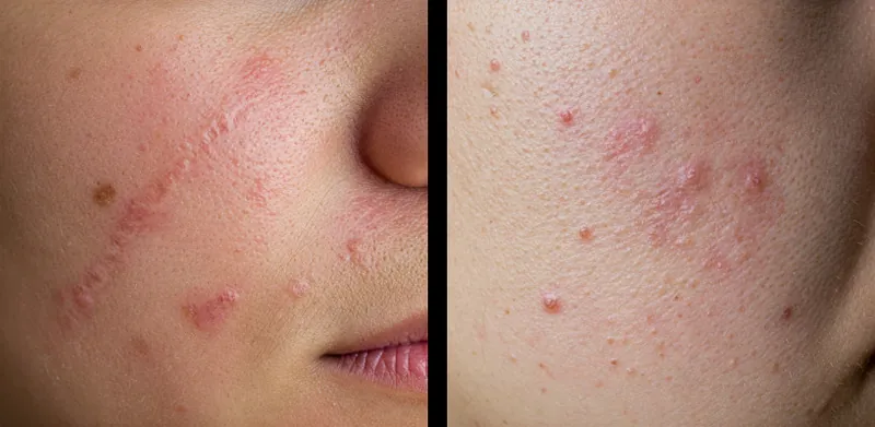 Understanding Acne Scars