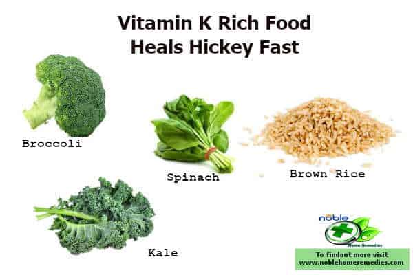 Intake of vitamin K rich food helps to heal hickeys fast. In addition could apply Vitamin K creams on hickey. It will speed up the healing of hickeys