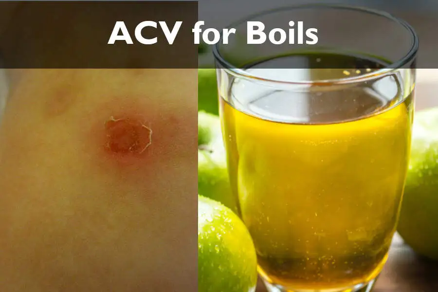 apple cider vinegar for boils