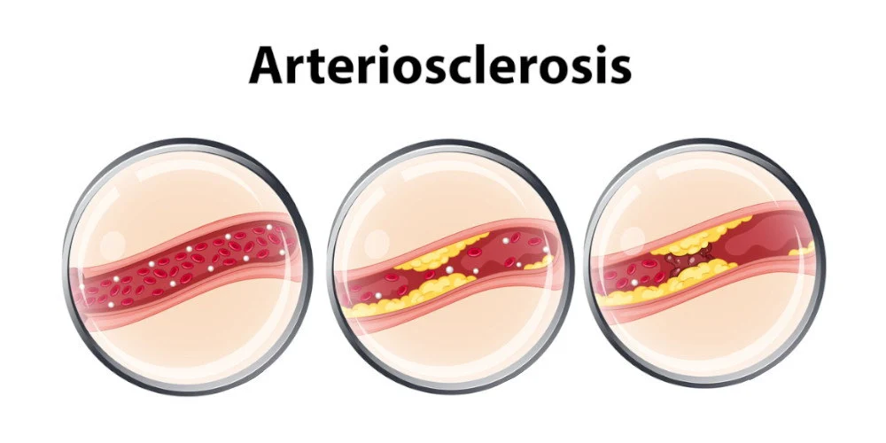 Arteriosclerosis with cholesterol deposits