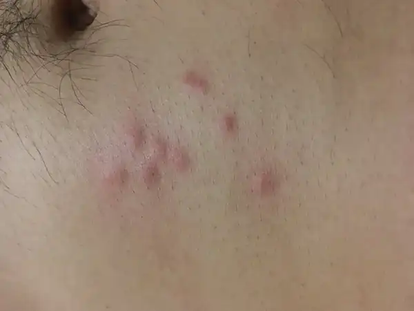 Bug Bite Photo