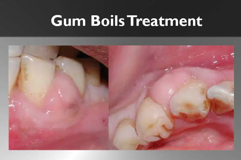 gum-boils-treatment-the-powerful-solution-you-need