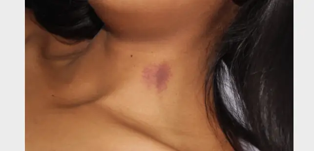 hickey on dark skin tone