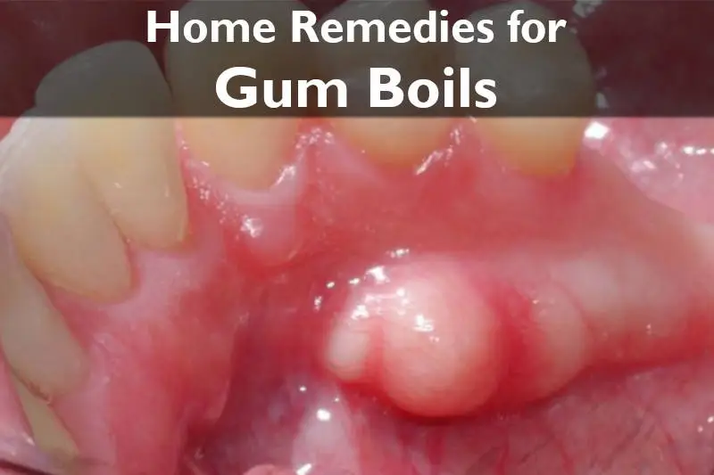 home remedies for gum boils cover image