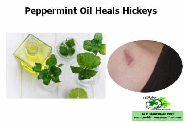 Peppermint properties stimulate blood circulation. It helps in clearing blood clots and healing hickeys fast