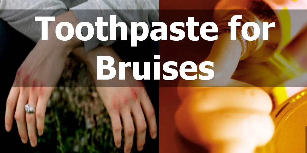 how to get rid of bruises with toothpaste