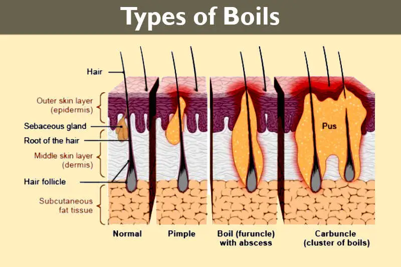 Types of boils