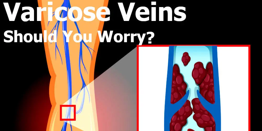 when to worry about varicose veins - should you really worry?